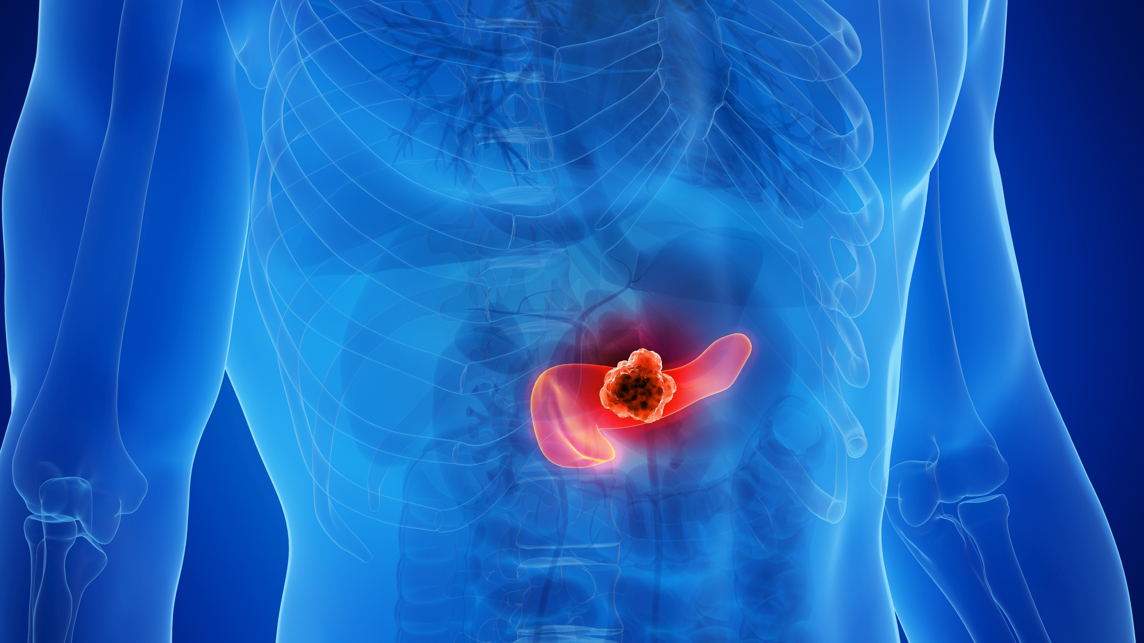 Triple-Targeted Therapy Achieves Durable Pancreatic Tumor Regression Preclinically