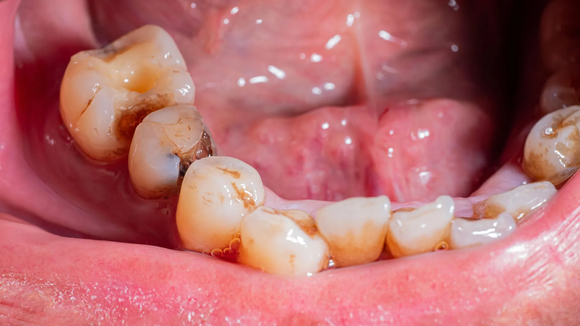 King's College Study Links Root Canal Treatment to Improved Blood Sugar and Heart Health