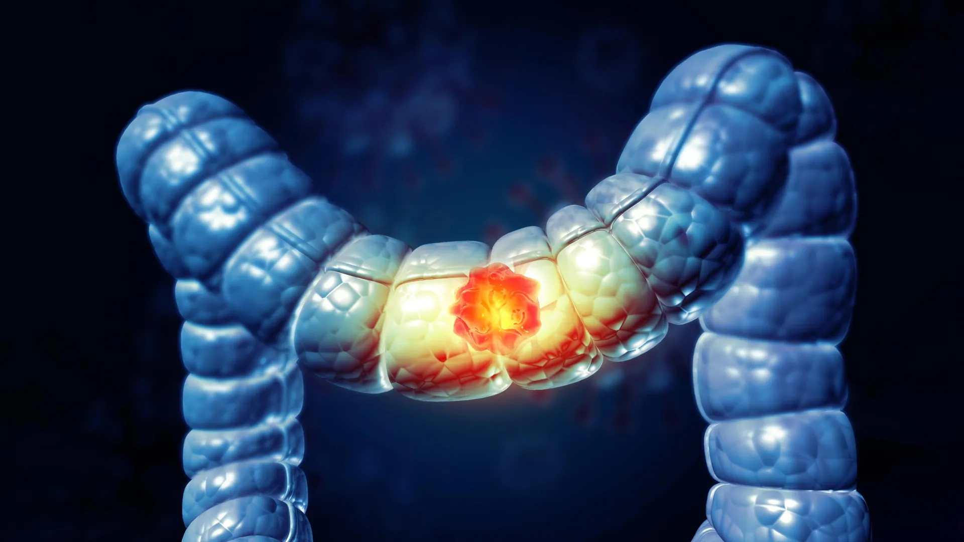 Poll Reveals Half of Americans Unaware Processed Meat Link to Colon Cancer