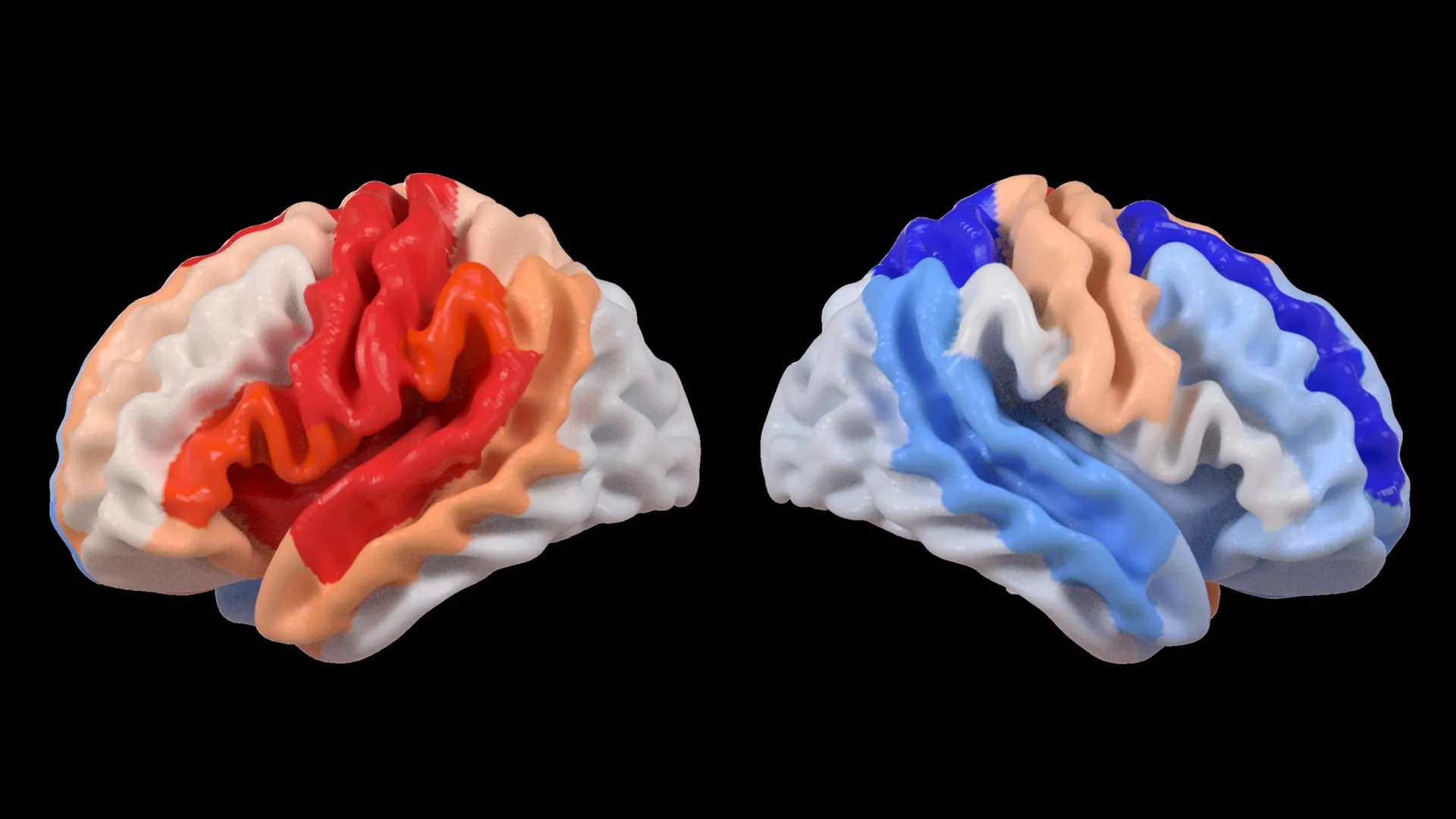USC Researchers Identify Brain Rejuvenation Patterns Following Severe Stroke